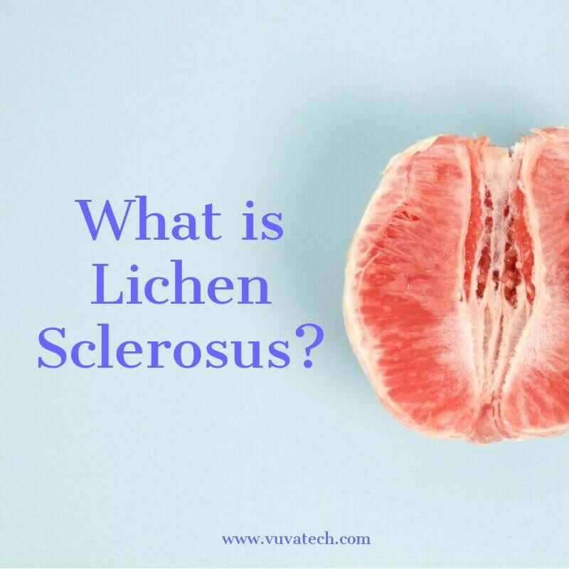 Lichen Sclerosus (LS): What it is and How to Manage Symptoms